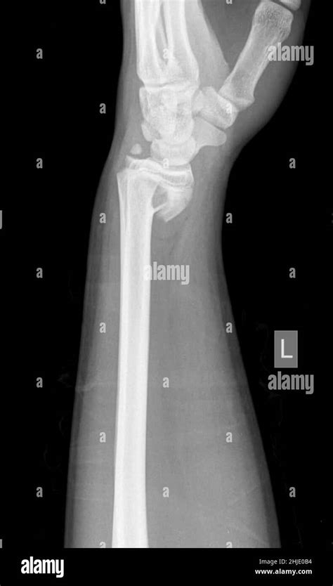 Smith fracture, X-ray Stock Photo - Alamy