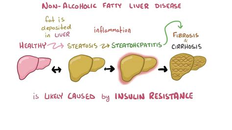 Non-alcoholic fatty liver disease: Video & Anatomy | Osmosis