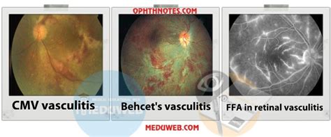 Retinal vasculitis - Meduweb