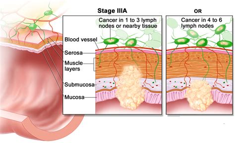 Colon Cancer Causes, Signs, Symptoms, Stages, Screening & Treatment