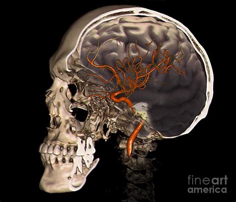 External Carotid Artery, 3d Ct Scan Photograph by Zephyr | Pixels