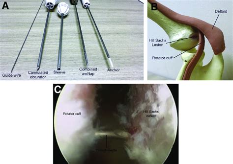 (A) Standard PASTA (partial articular supraspinatus tendon avulsion)... | Download Scientific ...