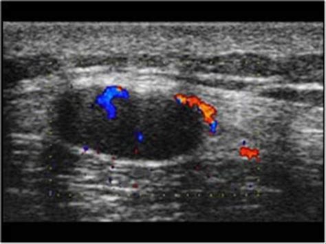 Thorax | 8.4 Thoracic wall : Case 8.4.5 Benign soft tissue lesions and ...