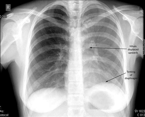 Lifting the veil: a case of lobar atelectasis | BMJ Case Reports