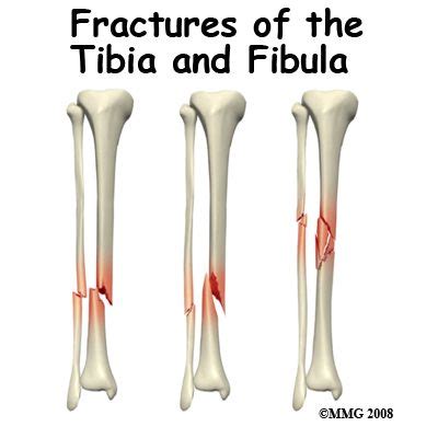 ADULT LOWER LEG FRACTURES - Physical Therapy in Litchfield