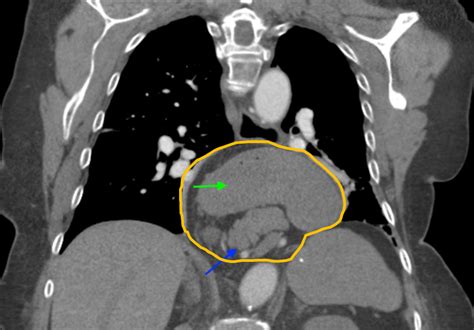 Cureus | Minding the Gap: Clinical Manifestations of a Rare Type IV Hiatal Hernia