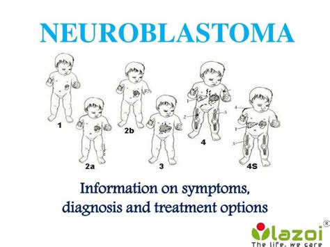 Neuroblastoma: Patient info on symptoms, diagnosis and treatment opti…