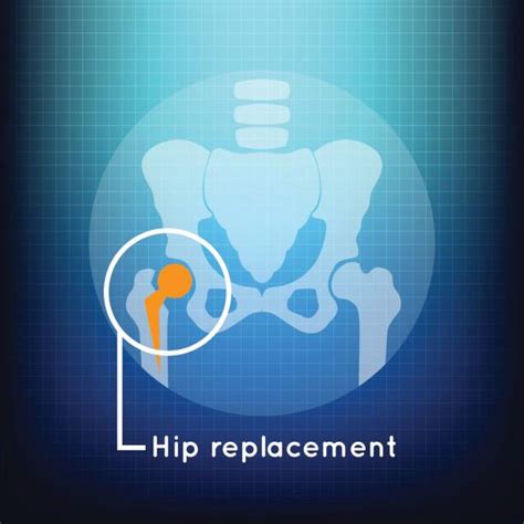 Royalty Free Hip Surgery Clip Art, Vector Images & Illustrations - iStock