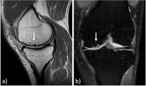 MRI evaluation at 11 years' follow-up of a medial femoral condyle... | Download Scientific Diagram