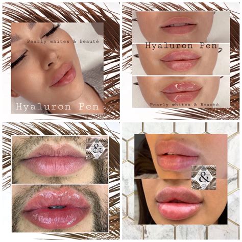 Hyaluron Pen lip fillers in 2021 | Lip fillers, Injectables fillers, Lips