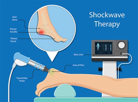 Shock Wave Therapy - Geelong Podiatry