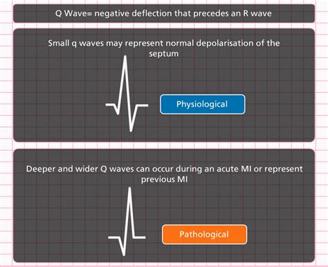 Pathologic q waves ecgpedia