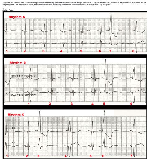 Ventricular Escape Beats and Fusion Beats with Interpretation by Dr Ken Grauer, MD