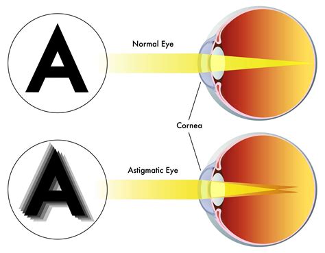 What Causes Astigmatism? - Heffington's of Springfield, MO