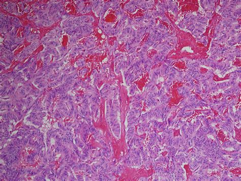 Pathology Outlines - Paraganglioma