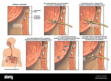 Percutaneous Endoscopic Gastrostomy (PEG TUBE Stock Photo: 7711750 - Alamy