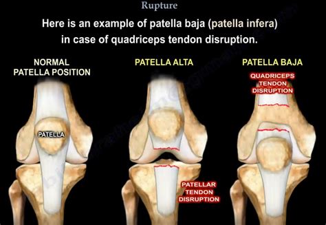 Quadriceps Tendon Rupture — OrthopaedicPrinciples.com