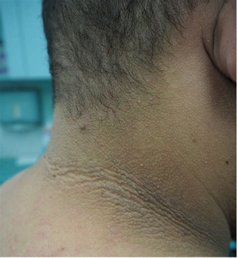 ACD A-Z of Skin - Acanthosis Nigricans