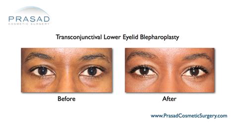 Lower Eyelid Surgery - Eyelifts by Dr. Amiya Prasad MD, FACS