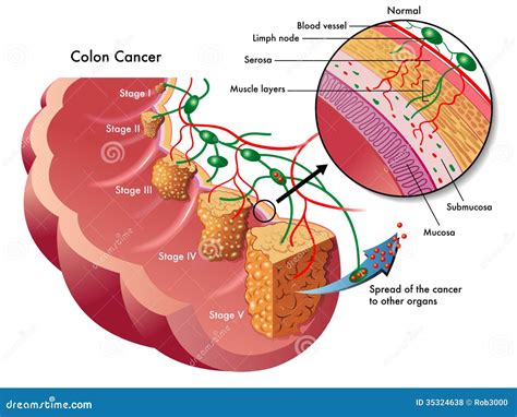 Colon Cancer Royalty Free Stock Photos - Image: 35324638