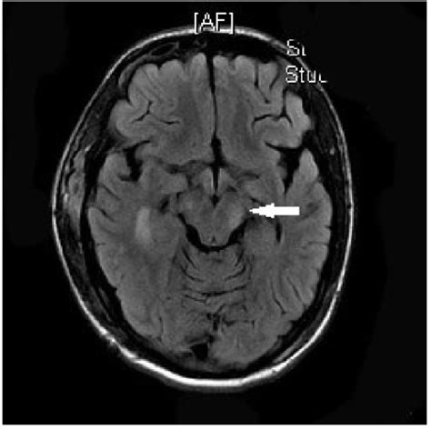 Postop MR demonstrating contralateral (left) cerebral c | Open-i