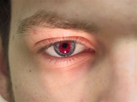 Medical Treatment Pictures-for Better Understanding: Diagnosis of Achromatopsia
