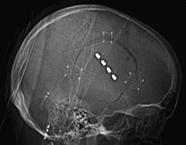 Motor Cortex Stimulation for Intractable Facial Pain | Clinical Gate