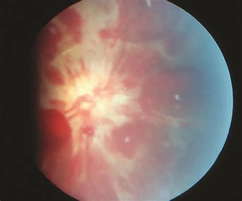 Retinal hemorrhages of abusive head trauma - American Academy of Ophthalmology