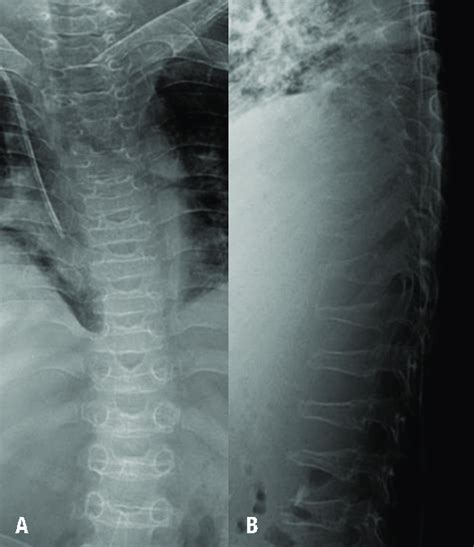 Radiographic image of the dysostosis multiplex. Spine radiogra phic ...