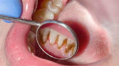 How probiotics help treat gum diseases?