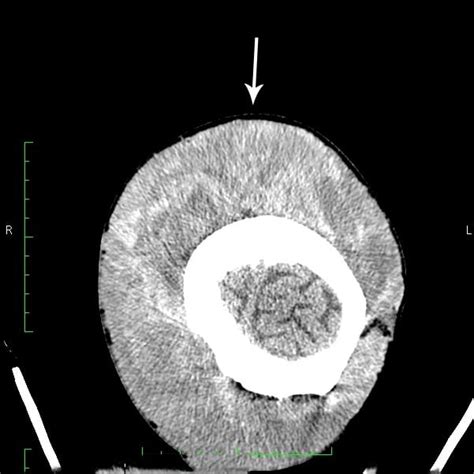 CEPHALOHEMATOMA VS SUBGALEAL HEMATOMA ULTRASOUND - Wroc?awski Informator Internetowy - Wroc?aw ...