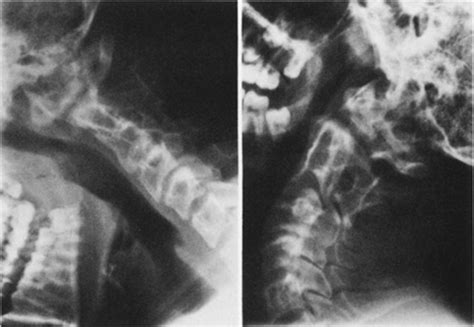 Familial os odontoideum in: Journal of Neurosurgery Volume 70 Issue 4 ...