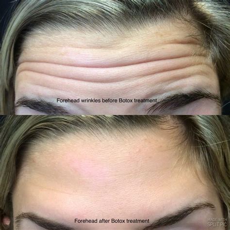 Botox Before and After Pictures - Deep Forehead Wrinkle, Lips