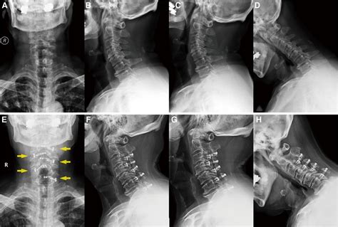 Frontiers | A novel surgical technique for cervical laminoplasty in ...