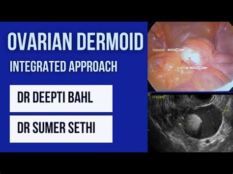 Dermoid Cyst Ovary- Clinicoradiological Approach - Sumer's Radiology Blog