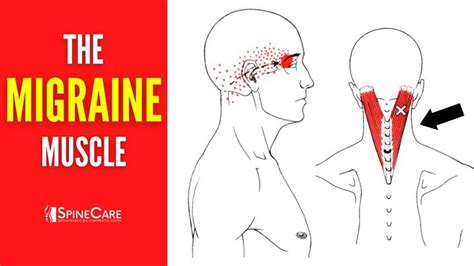 How to Release Tension for FAST MIGRAINE RELIEF | Migraine, Migraine relief, Fast migraine relief