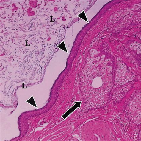 Teratoma Histology