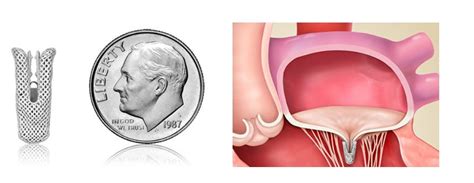 Webinar | MitraClip Procedure by Dr. Niraj Parkeh | May 5, 2020 - 5.00pm