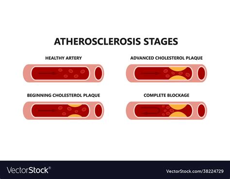 Atherosclerosis stages healthy and unhealthy Vector Image