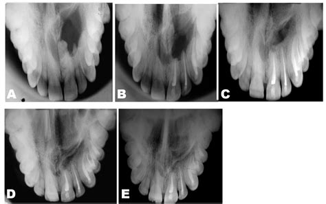 FULL TEXT - Management of an impacted inverted mesiodens associated ...