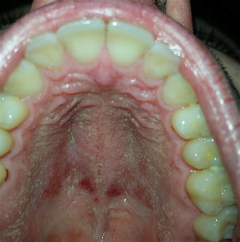 Rash on roof of mouth. Any advice appreciated : r/Dentistry