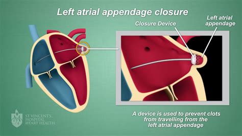 Left Atrial Appendage Closure Procedure