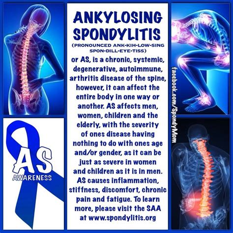 Hla B27 Positive Life & Hla B27 Positive in 2020 | Ankylosing spondylitis, Autoimmune arthritis ...