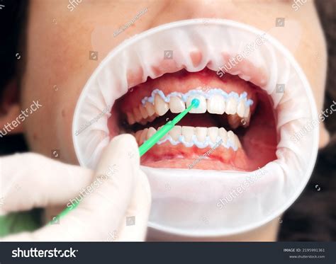 19 Oral Hydrogen Peroxide Images, Stock Photos, 3D objects, & Vectors | Shutterstock