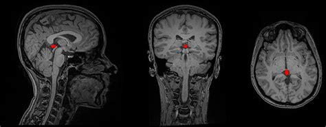 Pineal Gland Mri