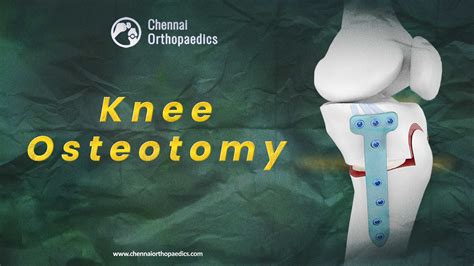 Knee Osteotomy for Early-Stage Osteoarthritis-Knee Surgery