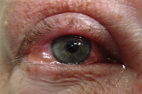 Allergic eye disease: itching to know more? - eyeonoptics