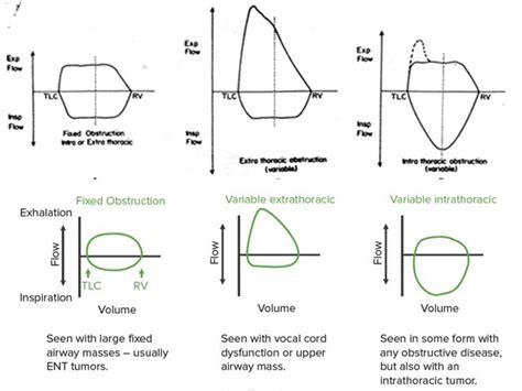 Flow Volume Loops in Spirometry - Pulmonology.weebly.com