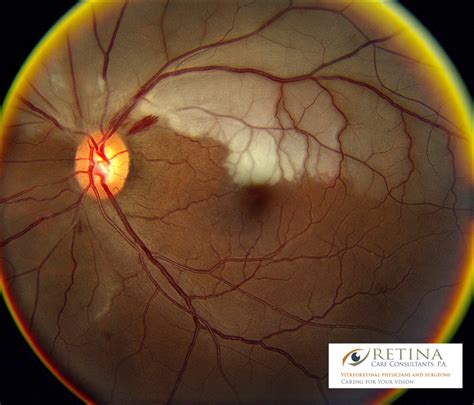 Central Retinal Artery Occlusion Anatomy