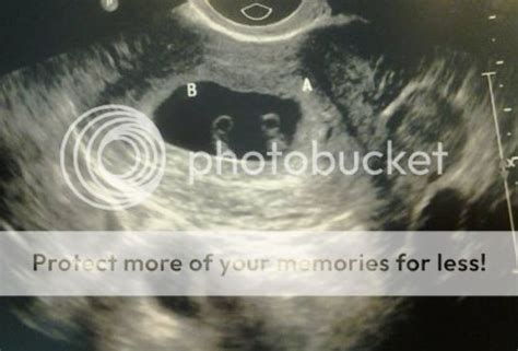 Monoamniotic twins... (Pic) - BabyCenter